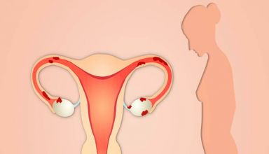 O que é endometriose? Conheça os sintomas e como tratar