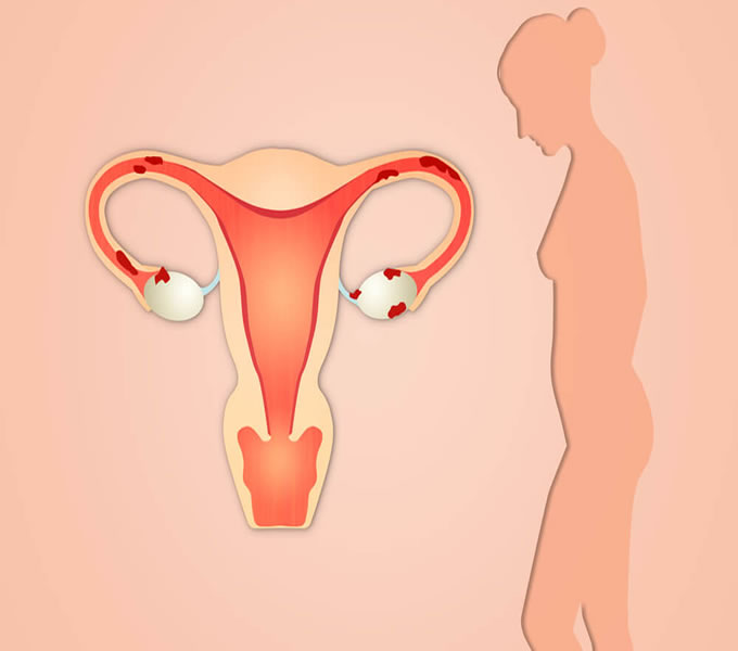 endometriose