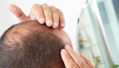 Entenda as causas da calvície e saiba como tratá-la