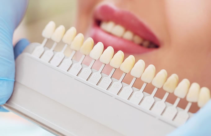 Clareamento dental quais são os tipos?