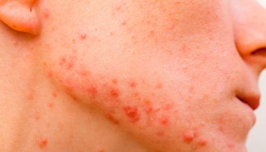 espinha-inflamada-saiba-como-tratar-e-aliviar-dor-e-inchaco