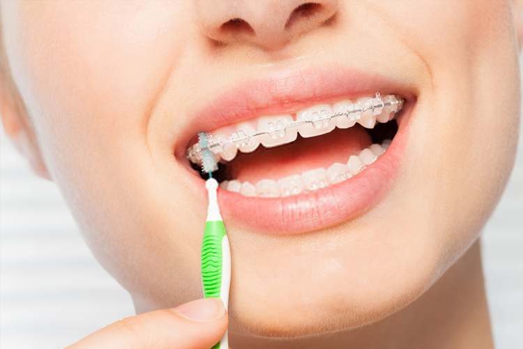 como escolher escova de dente para aparelho fixo